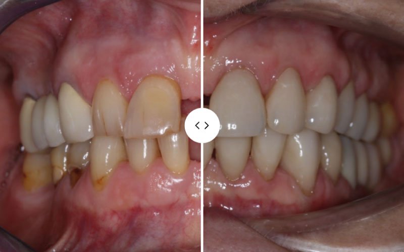 dlugosz stomatologia licowki przed i po