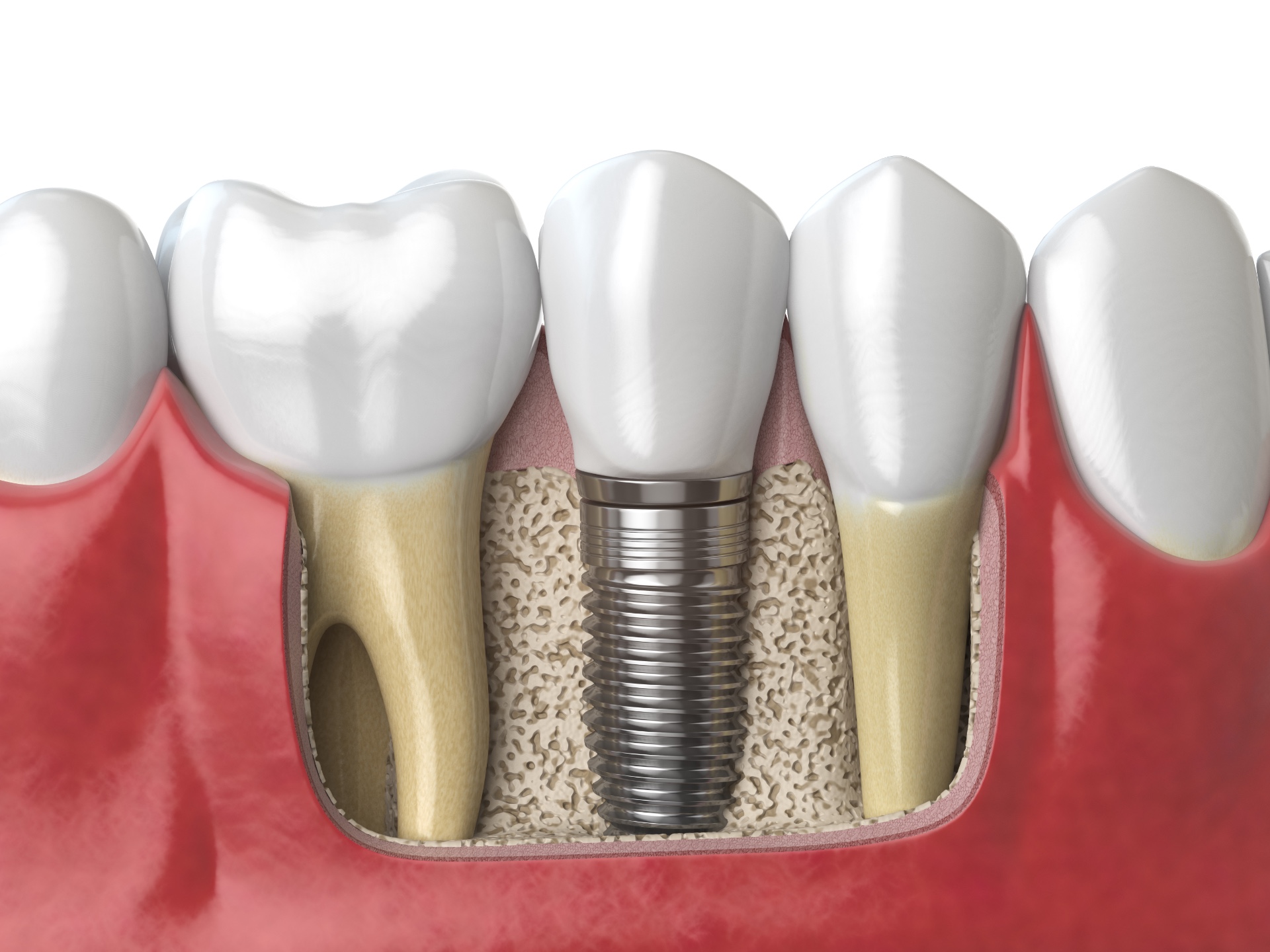 Implanty zębów Kraków – model 3D w przekroju przedstawiający tytanowy implant zębowy z koroną wszczepiony w kość, umiejscowiony pomiędzy naturalnymi zębami